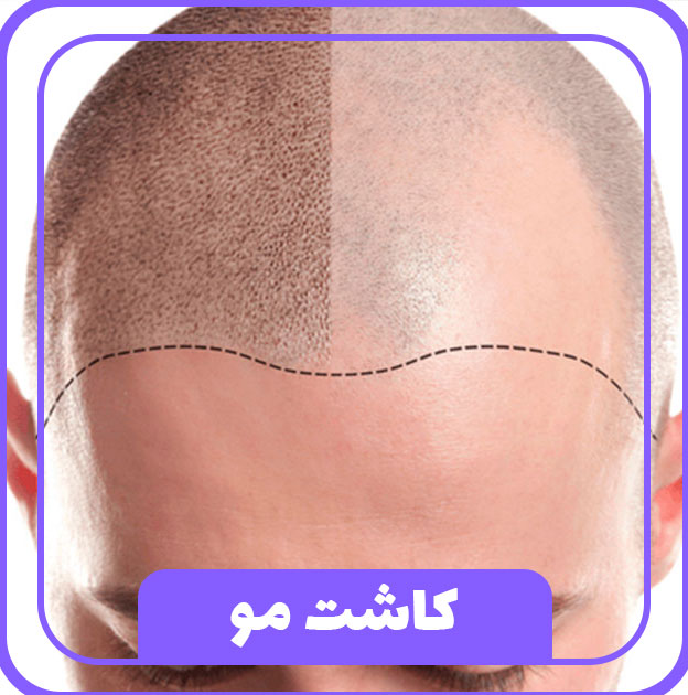 کاشت مو