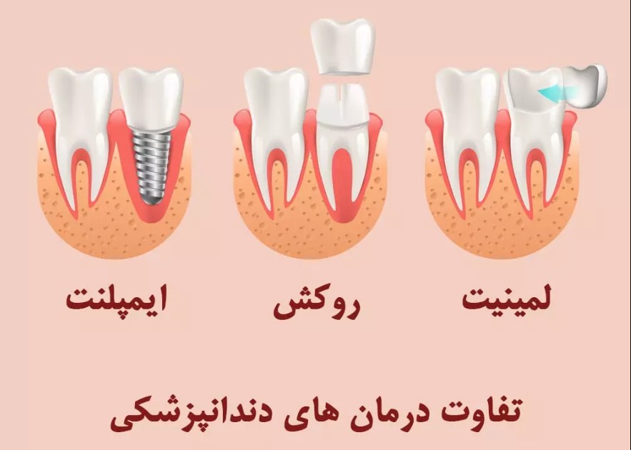 ایمپلنت دندان اسلامشهر | کلینیک دندانپزشکی در اسلامشهر