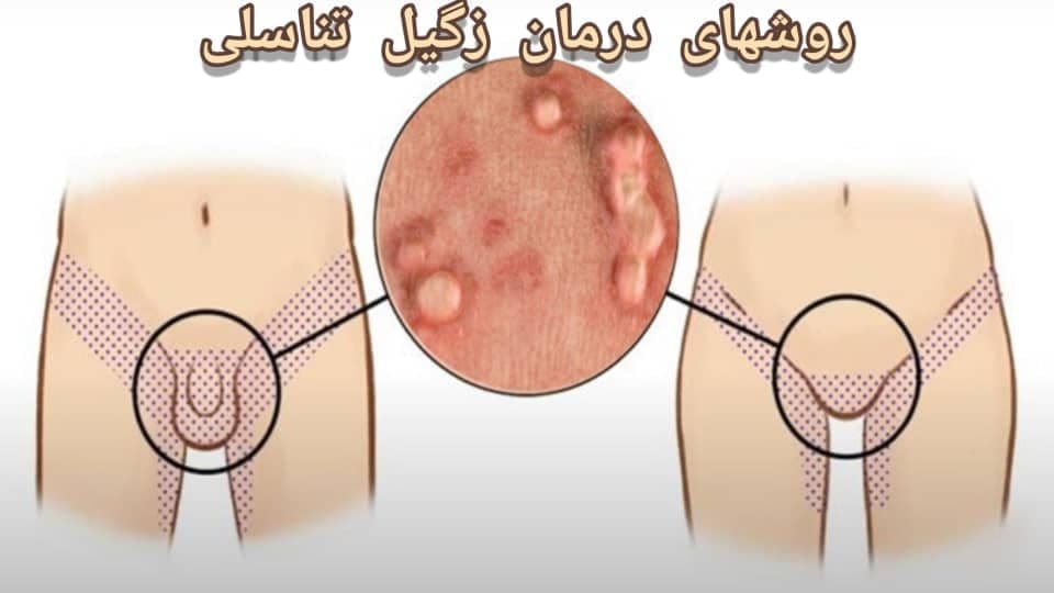 زگیل | زگیل تناسلی