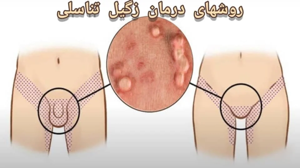 زگیل تناسلی