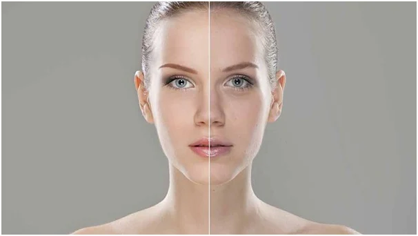 What is hifu face and how long does it last?