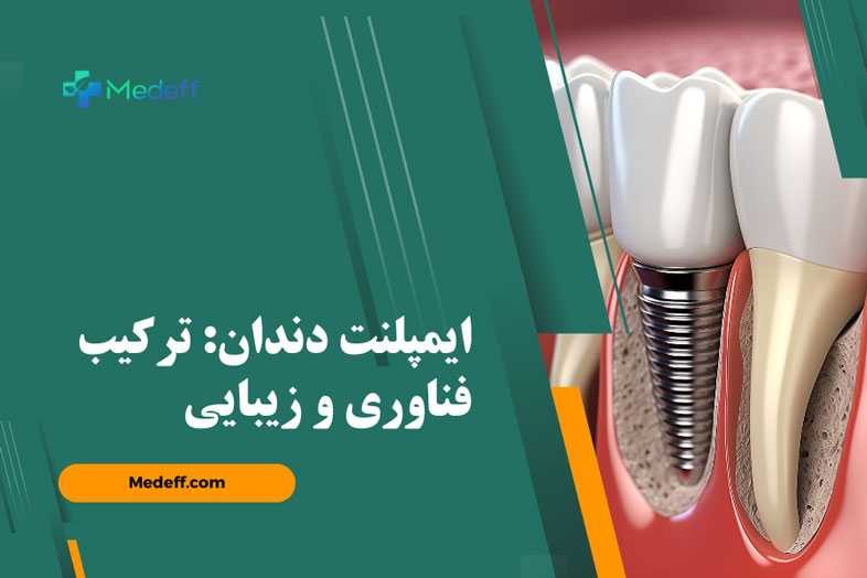 ایمپلنت | فناوری