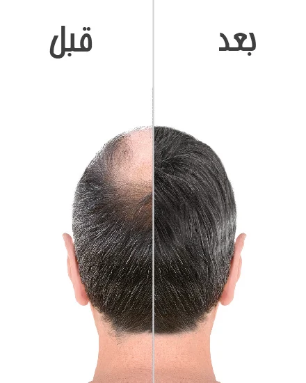ریزش مو