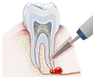 خطرات ناشی از عدم درمان دندان عفونی