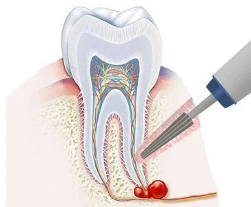 خطرات ناشی از عدم درمان دندان عفونی